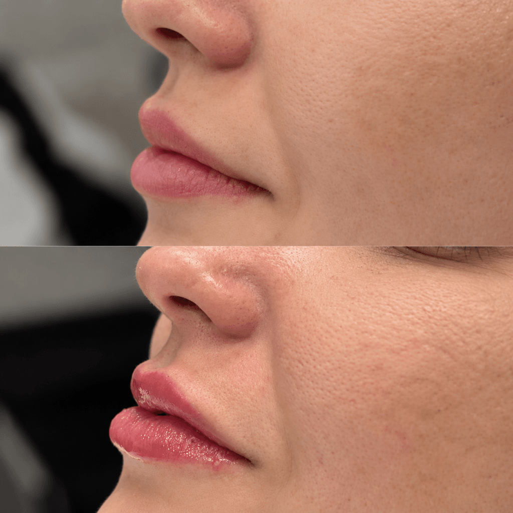 Preenchimento labial de uma paciente em close lateral: antes no alto, depois embaixo
